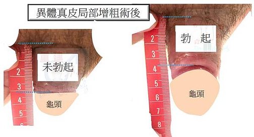 異體真局部皮陰莖增粗%26;割包皮術後-未勃起%26;勃起.jpg