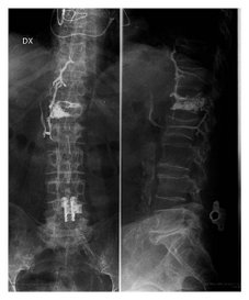 Cement-leakage-into-the-Batsons-paravertebral-venous-system.png