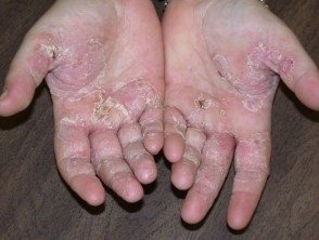 palm-derm.jpg