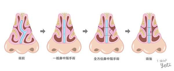 Chen-Doctor-nasal_septum2-5