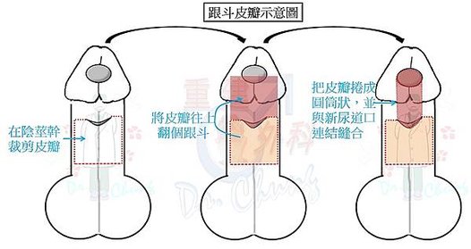 跟斗皮瓣示意圖.jpg