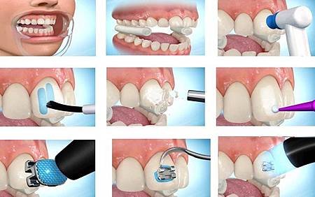 「orthodontic bracket bonding」的圖片搜尋結果