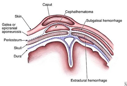 caput-and-cephal.jpg