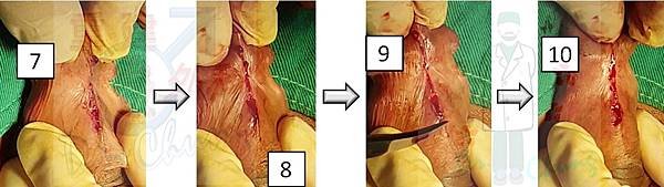包皮環切前後的繫帶變化--個案探討(上) (The case