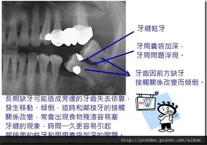 缺牙導致牙齒接觸關係改變。