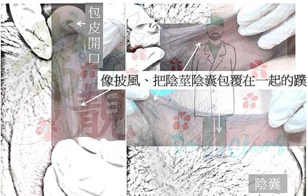 陰莖包皮蹼.jpg