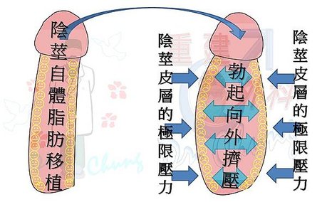 陰莖自體脂肪移植.jpg