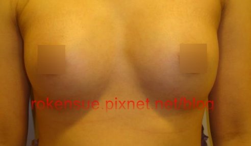 breast a9.jpg