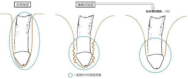 陰莖根部-3.jpg