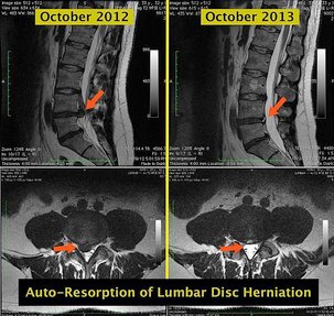 Resorption-of-lumbar-disc-herniation.jpg