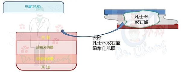 陰莖注射凡士林/石蠟的處理架構(The treatment 