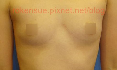 breast a8.jpg