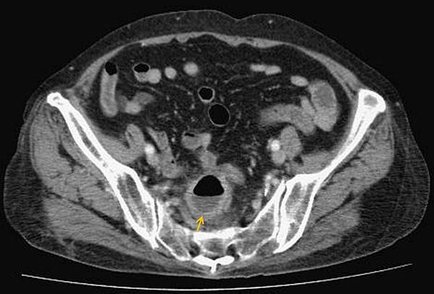 sigmoid colon abscess.CTjpg