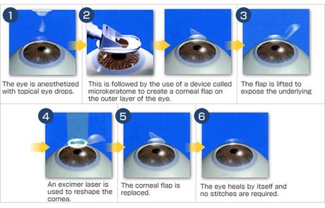 img_01_lasik.jpg