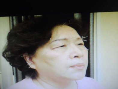 眼肌無力針灸溫崇凱中醫師.jpg