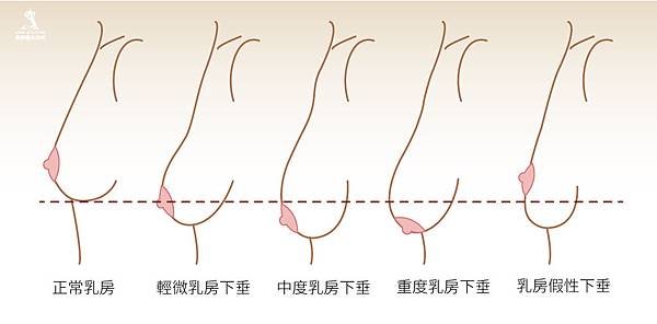 隆乳費用隆乳心得隆乳ptt隆乳照片果凍矽膠隆乳費用隆乳水滴果凍矽膠隆乳水滴隆乳費用水滴隆乳心得水滴型果凍矽膠隆乳費用水滴型隆乳觸感水滴隆乳觸感水滴隆乳ptt極緻醫美02.jpg