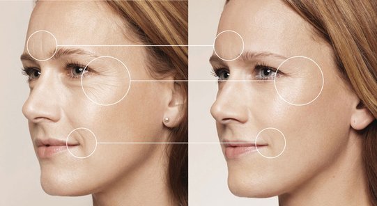 Restylane-before-after_001.jpg