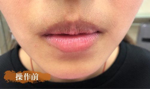 唇 操作前(正).jpg