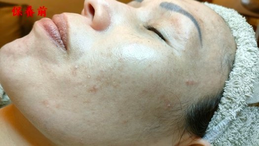 臉部色素斑點淨化