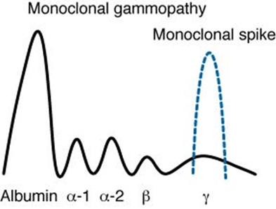 monoclonal_gammopathy1353218939541.png