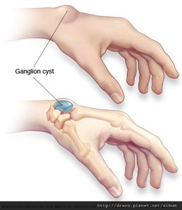 ds00767_im00035_mcdc7_ganglion_cystthu_jpg.png