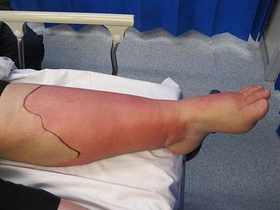 cellulitis-on-the-leg-image-credit-john-campbell-2018.jpg