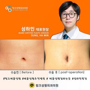배꼽성형전후_링크성형외과_성하민원장.jpg