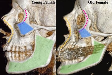 少女計劃林上立醫生液態拉皮上立提 液態拉皮 推薦 3D聚左旋乳酸 舒顏萃 童顏針 3D聚左旋乳酸 價格 3D聚左旋乳酸 費用 Ellansé 洢蓮絲少女針PolycaprolactonePCL膠原增生劑易麗適依戀詩法令紋木偶紋淚溝眼袋01.jpg