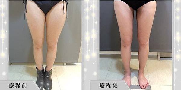 抽脂腿部