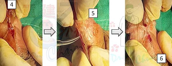 包皮環切前後的繫帶變化--個案探討(上) (The case