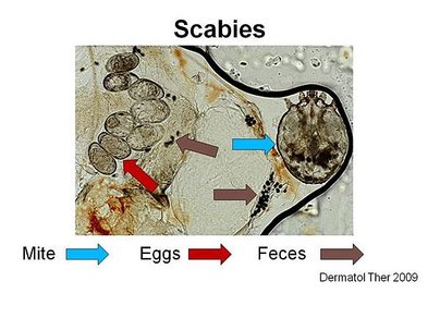 scabies.jpg