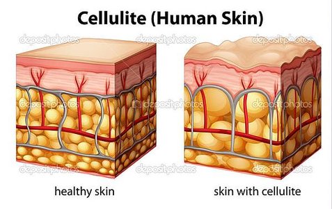 depositphotos_26395397-Cellulite[1]