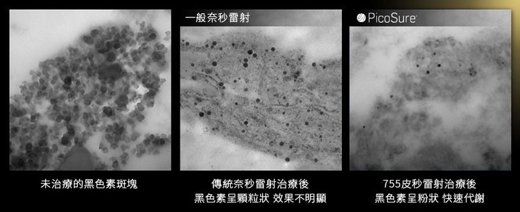 PicoSure755蜂巢皮秒雷射皮秒雷射蜂巢透鏡膠原蛋白除斑美白好膚質毛孔細紋凹疤美肌博士 (5).jpg