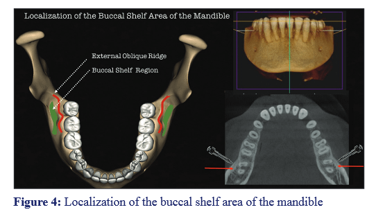 @齒顎矯正每日一說~~0225 buccal shelf m