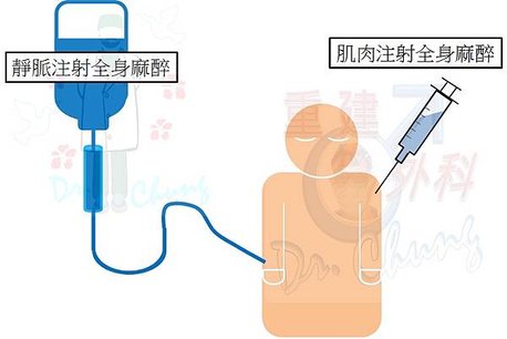 靜脈或肌肉注射全身麻醉.jpg