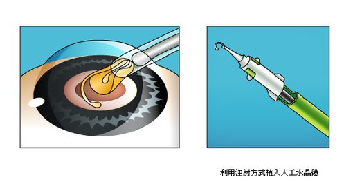 白內障手術2