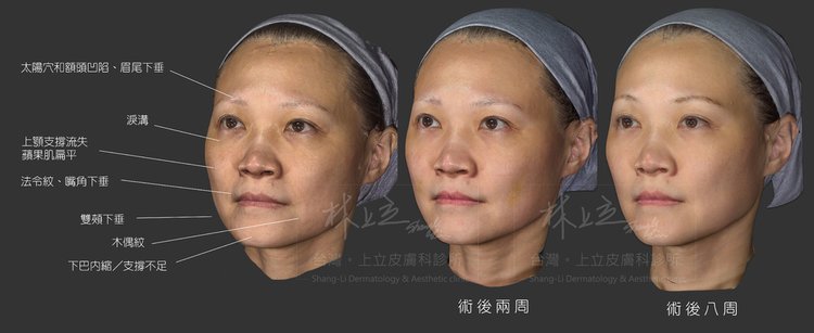 【艾麗斯效果】AestheFill®艾麗斯術後 這些人心得分