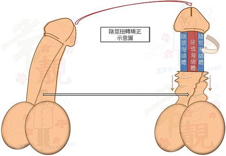 扭轉矯正示意圖.jpg