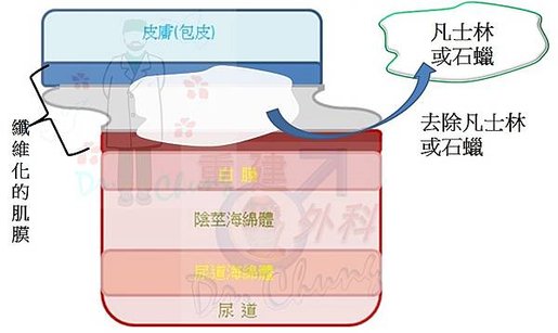 陰莖注射凡士林/石蠟的處理架構(The treatment 