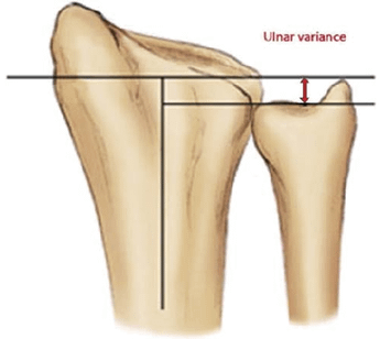 Fig-3-Ulnar-variance.png