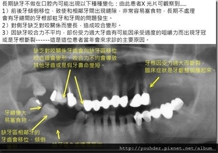 缺牙過久的後遺症實例