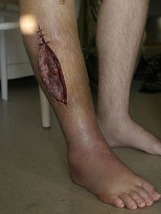 300px-Fasciotomy_leg.jpg