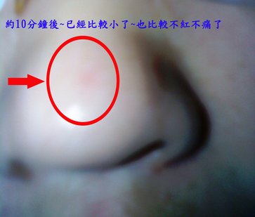 痘03.jpg