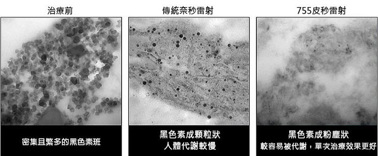 PicoSure755皮秒雷射蜂巢式聚焦陣列透鏡蜂巢透鏡皮秒雷射蜂巢皮秒雷射反黑除斑術後保養6.jpg