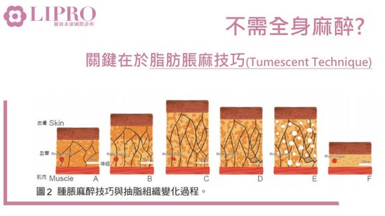 顯微套管抽脂【抽脂】為什麼不需全身麻醉？ 達到抽脂高度安全-1030-2.jpg