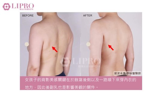 顯微套管抽脂｜去去副乳不要來！副乳手術後，乳腺怎麼辦-1030-10.jpg