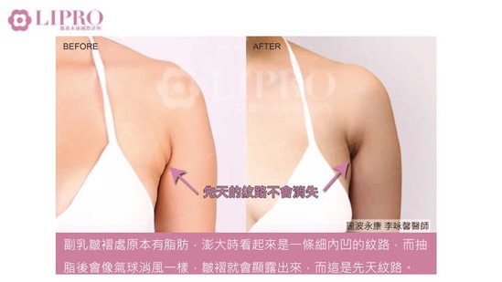 顯微套管抽脂｜去去副乳不要來！副乳手術後，乳腺怎麼辦-1030-11.jpg