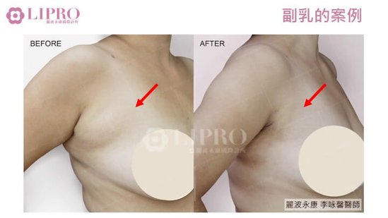 顯微套管抽脂｜去去副乳不要來！副乳手術後，乳腺怎麼辦-1030-16.jpg