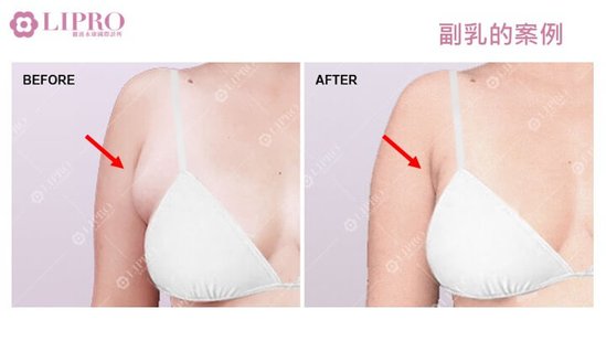 顯微套管抽脂｜去去副乳不要來！副乳手術後，乳腺怎麼辦-1030-18.jpg