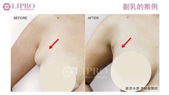 顯微套管抽脂｜去去副乳不要來！副乳手術後，乳腺怎麼辦-1030-15.jpg